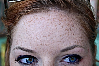 Freckled forehead